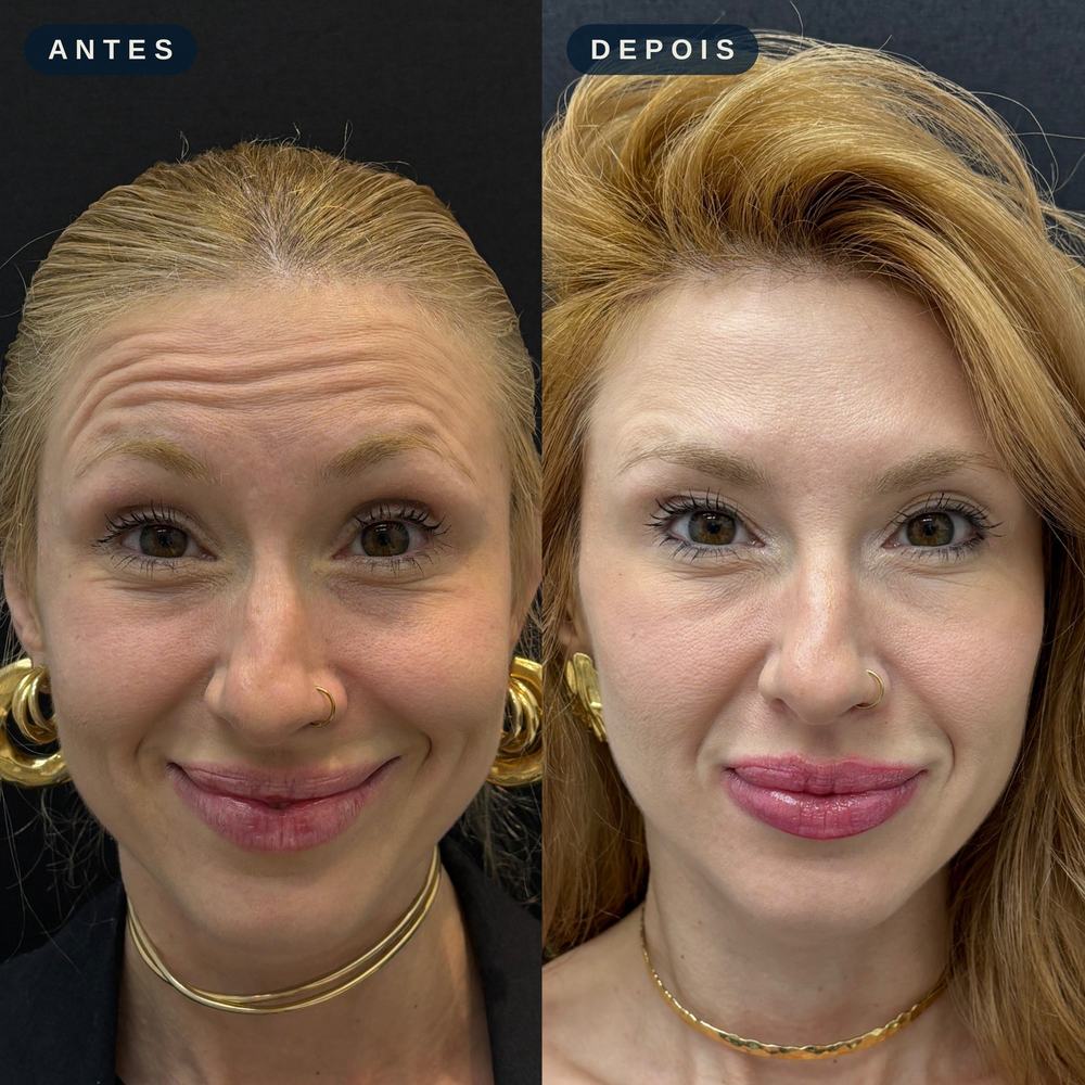 Antes e depois - Linhas de Expressão