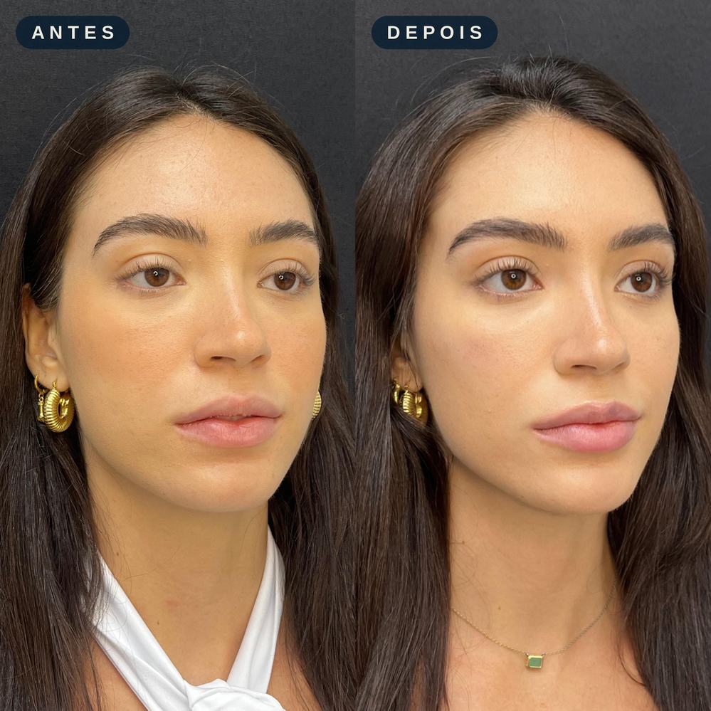 Antes e depois - Contorno e Definição Facial