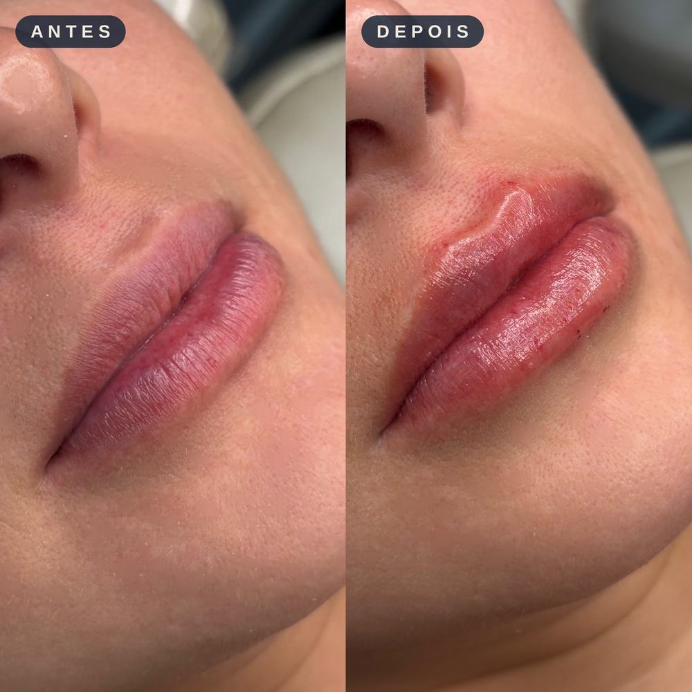 Antes e depois - Contorno e Volume Labial