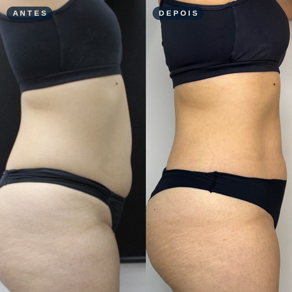 Antes e depois - Definição e Contorno Corporal