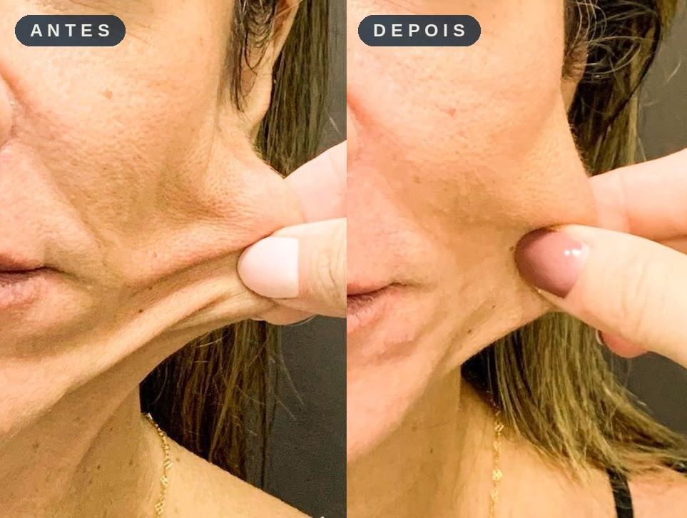 Antes e depois - Estímulo de Colágeno