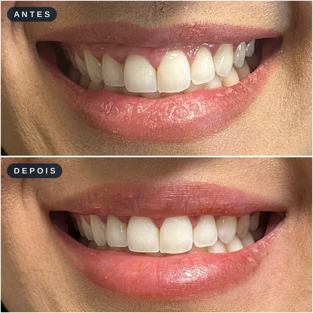Antes e depois - Sorriso Gengival