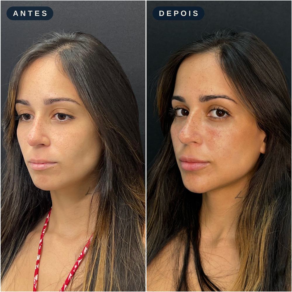 Antes e depois - Contorno e Definição Facial
