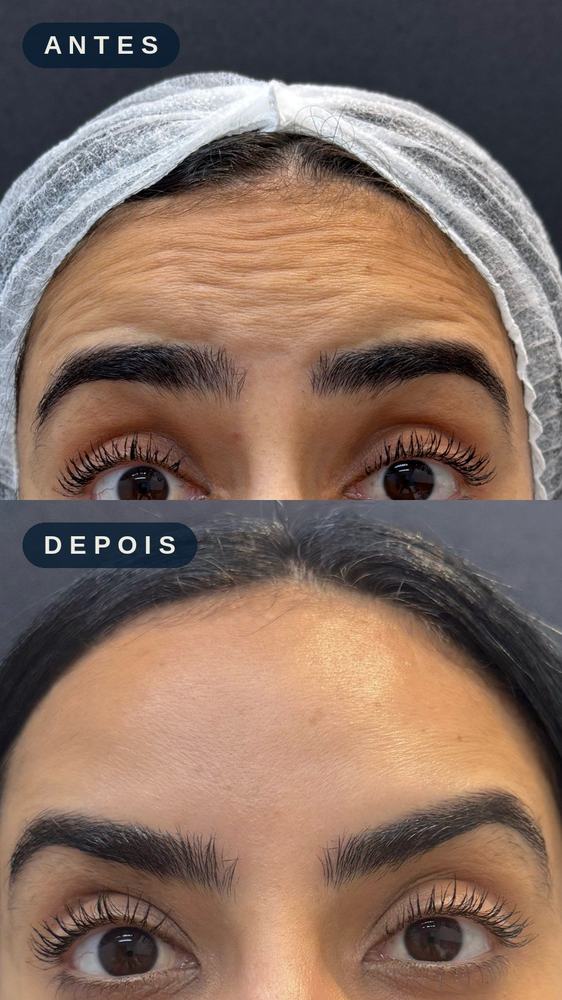 Antes e depois - Linhas de Expressão