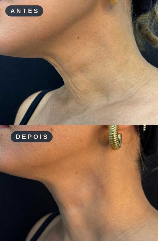 Antes e depois - Estímulo de Colágeno