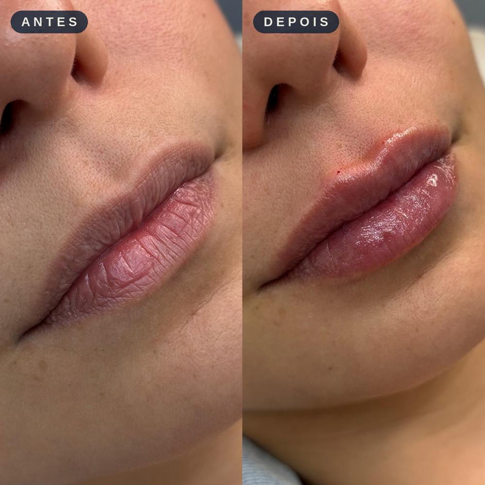 Antes e depois - Contorno e Volume Labial