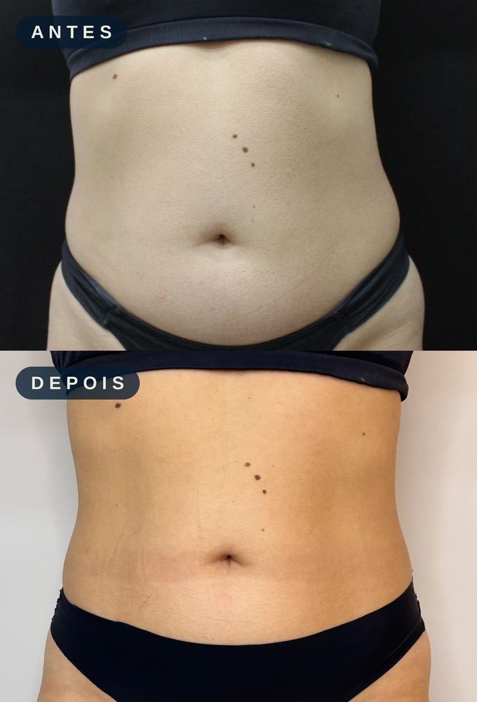 Antes e depois - Definição e Contorno Corporal
