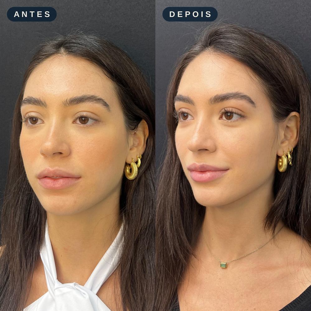 Antes e depois - Contorno e Definição Facial