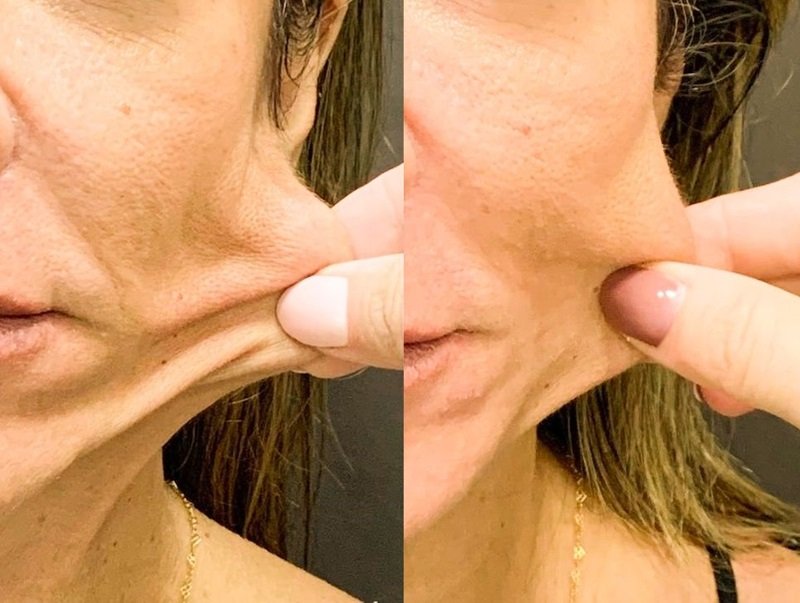 Bioestimulador de Colágeno - antes e depois - Cesof