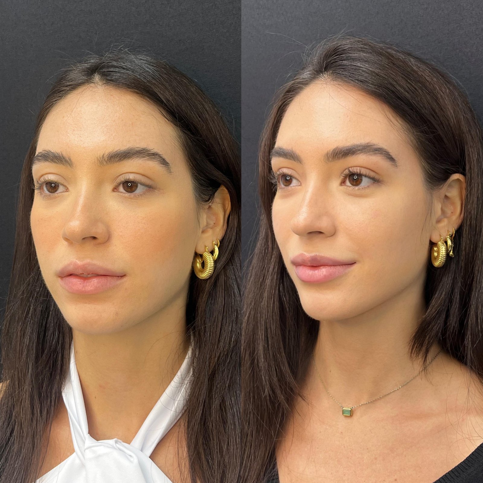 Preenchimento Facial - antes e depois - Cesof