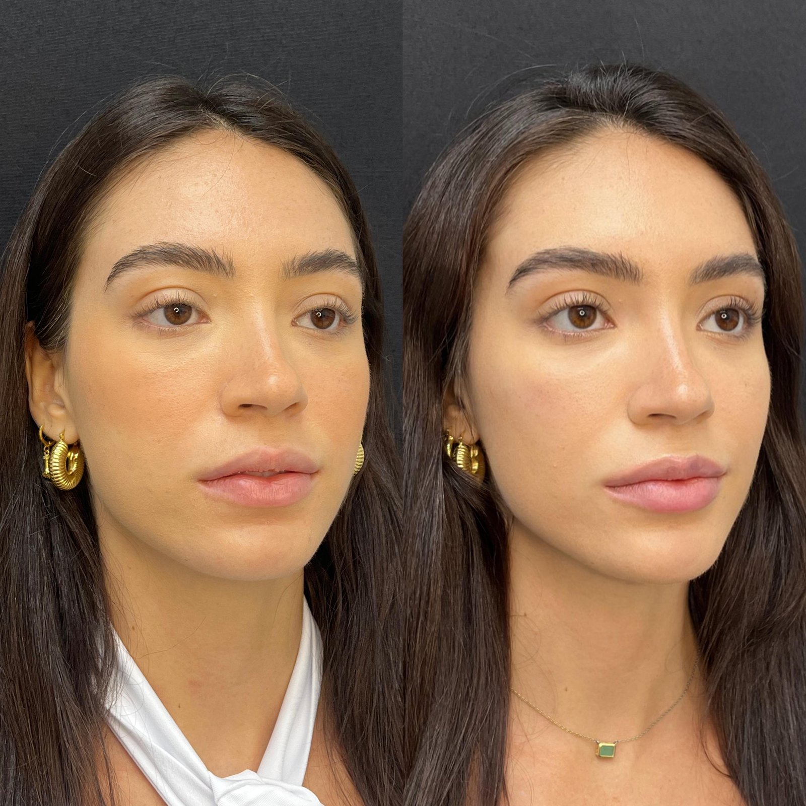 Preenchimento Facial - antes e depois - Cesof