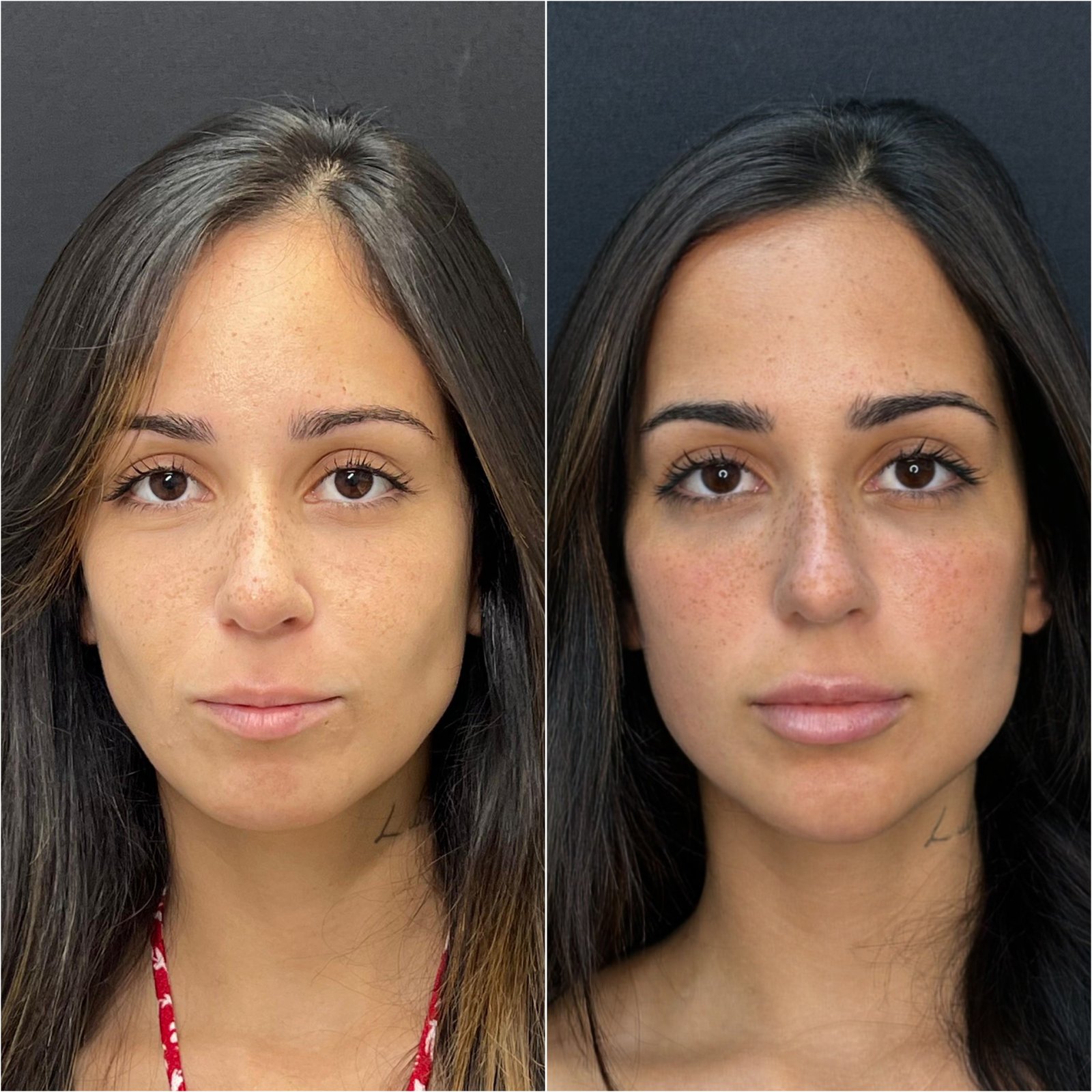 Preenchimento Facial - antes e depois - Cesof