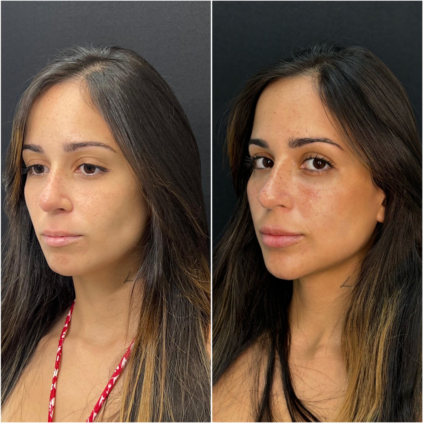 Preenchimento Facial - antes e depois - Cesof
