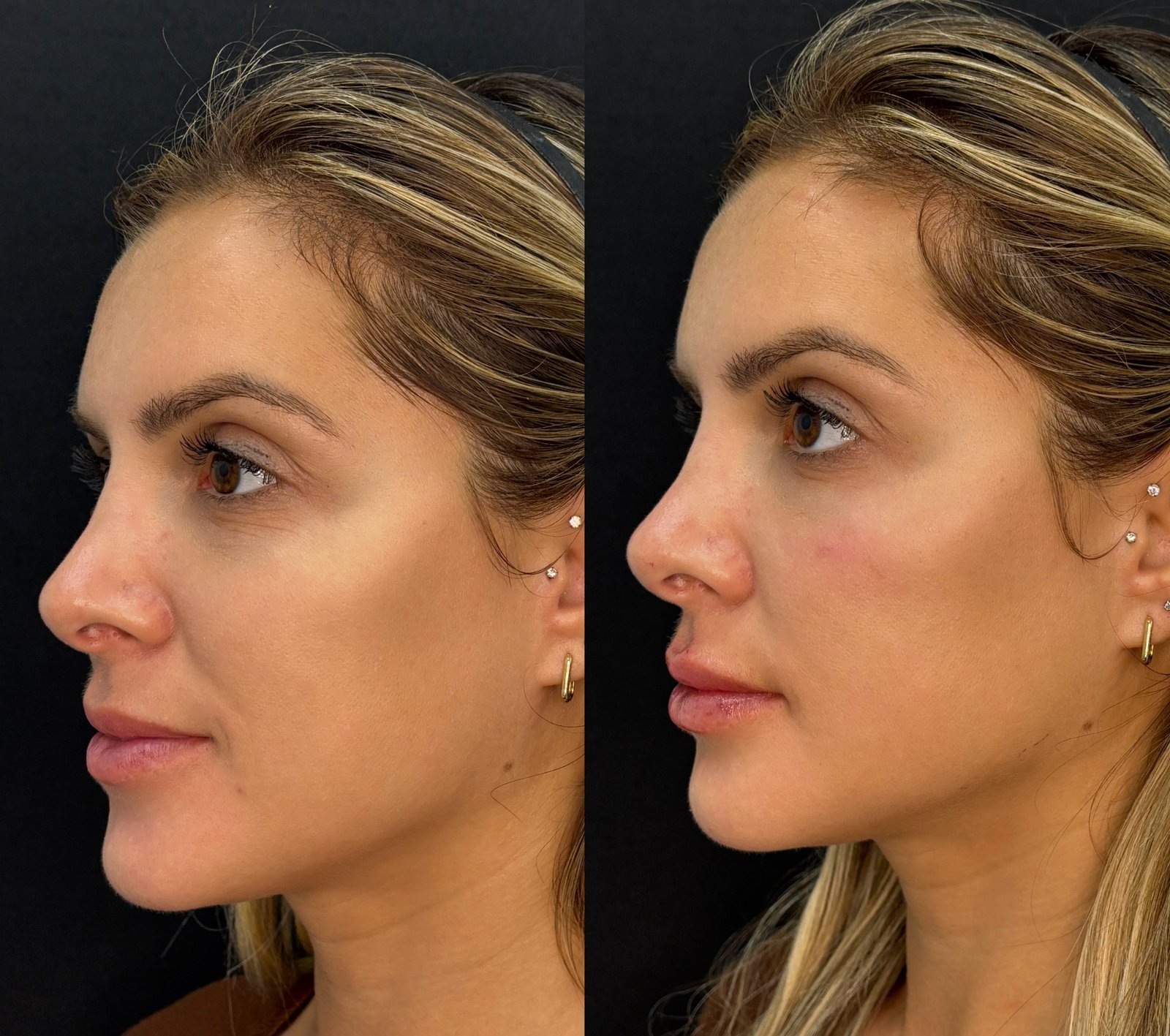 Preenchimento Facial - antes e depois - Cesof