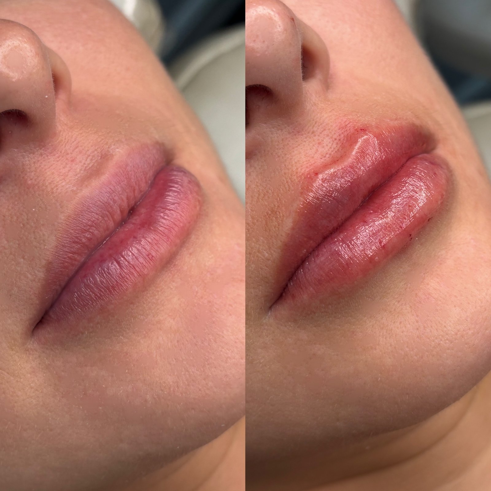 Preenchimento Labial - antes e depois - Cesof