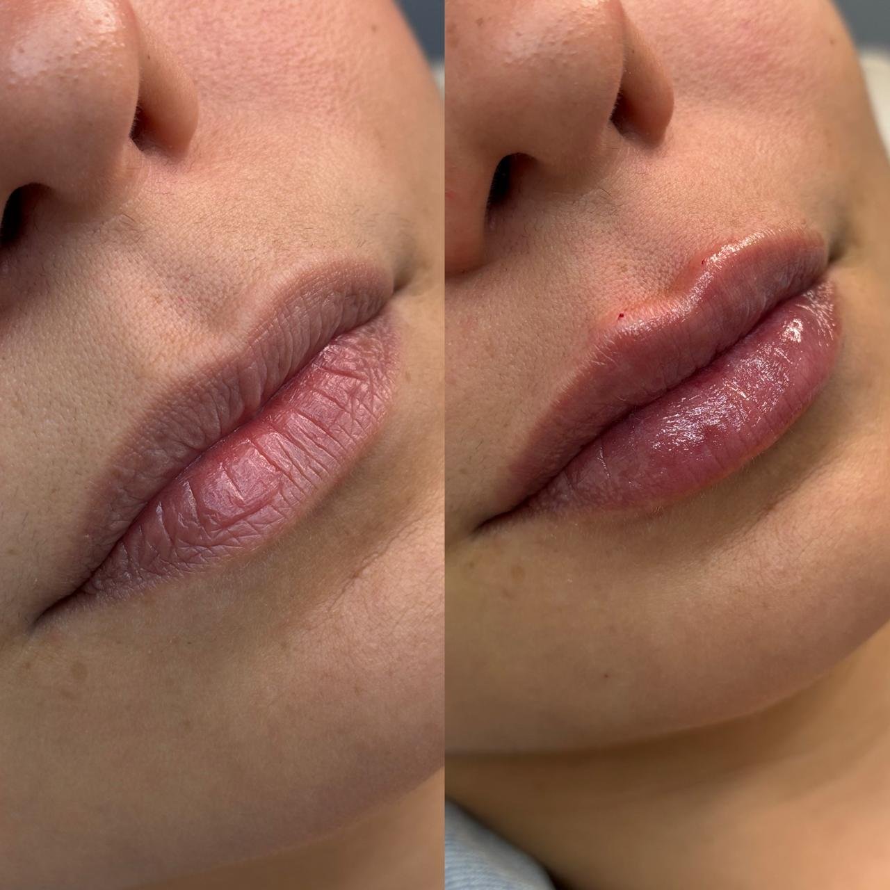 Preenchimento Labial - antes e depois - Cesof