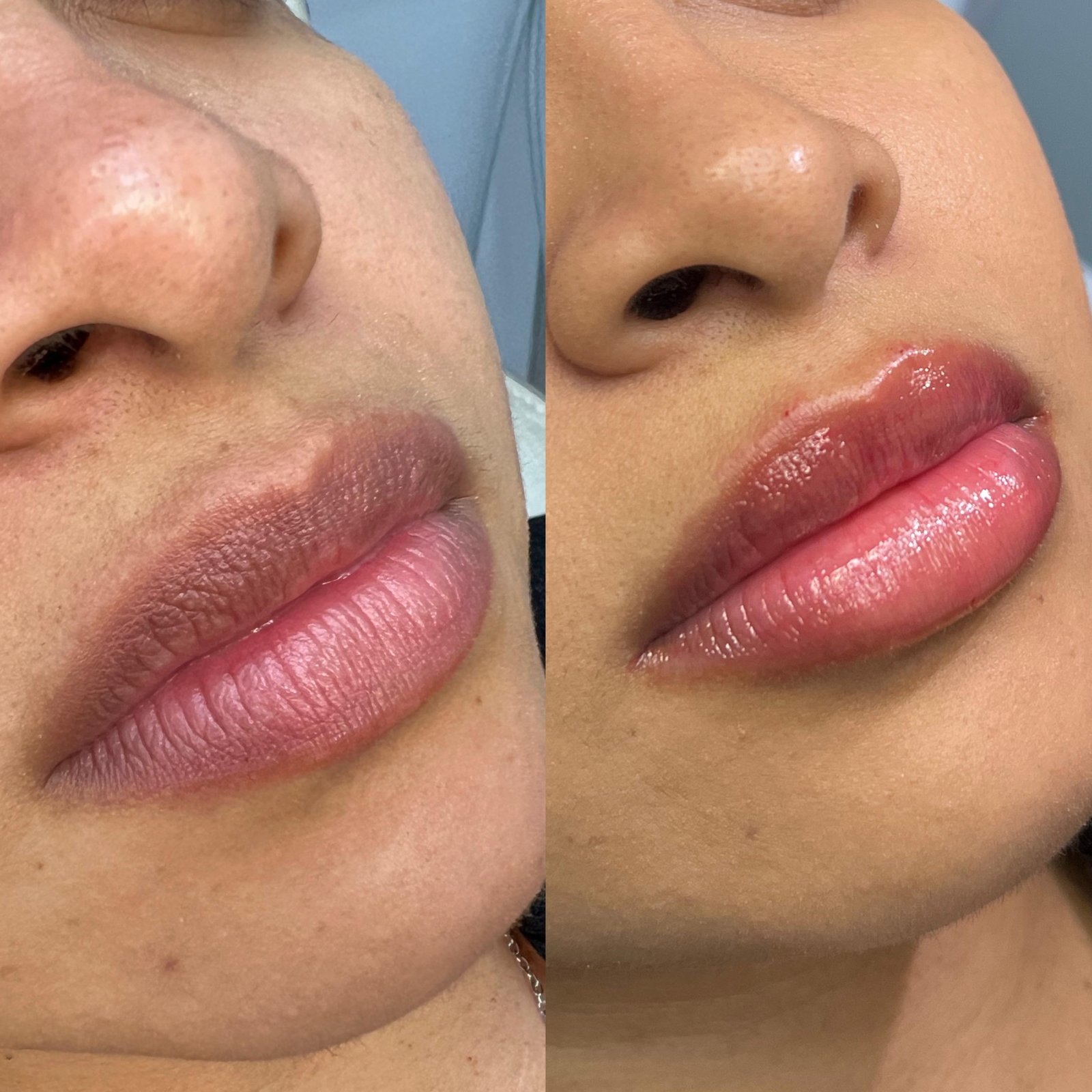 Preenchimento Labial - antes e depois - Cesof