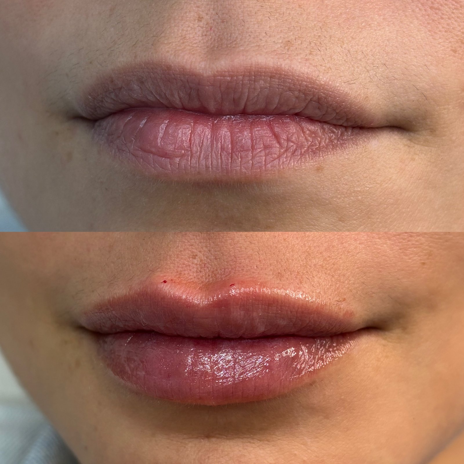 Preenchimento Labial - antes e depois - Cesof