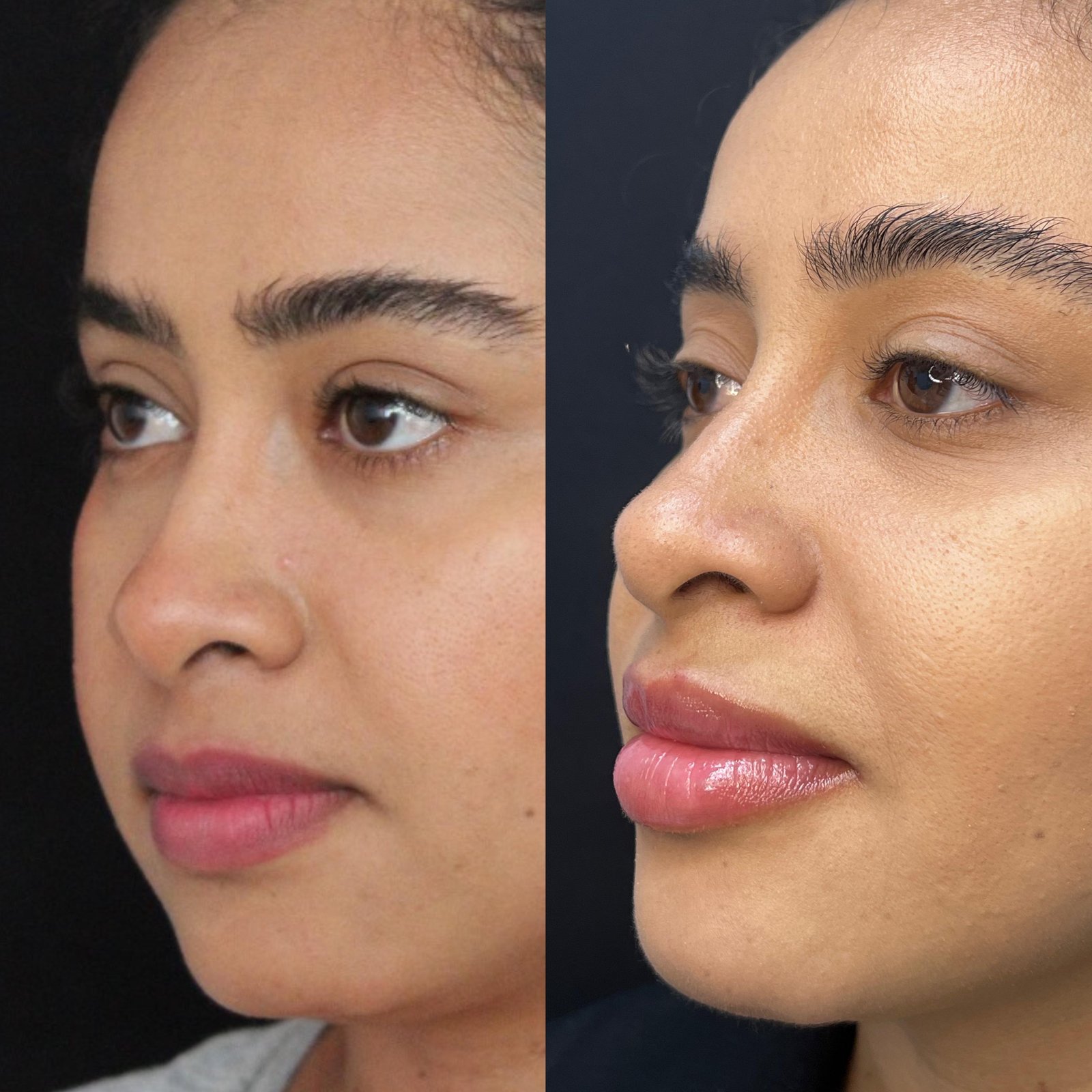 Preenchimento Labial - antes e depois - Cesof