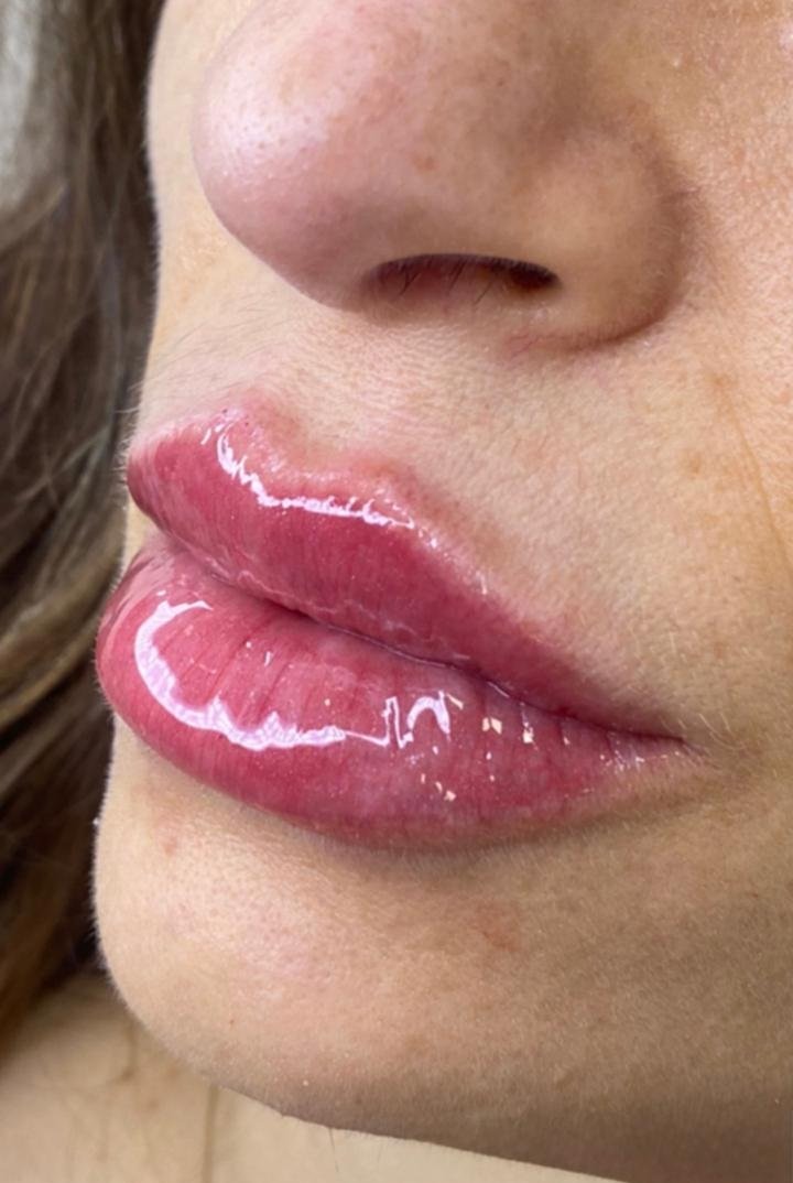 Preenchimento Labial - resultado final - Cesof