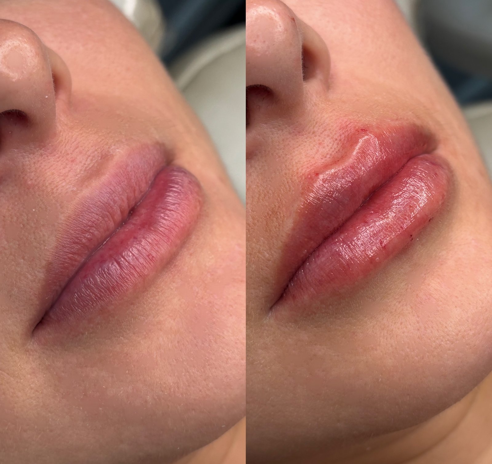 Preenchimento Labial - antes e depois - Cesof
