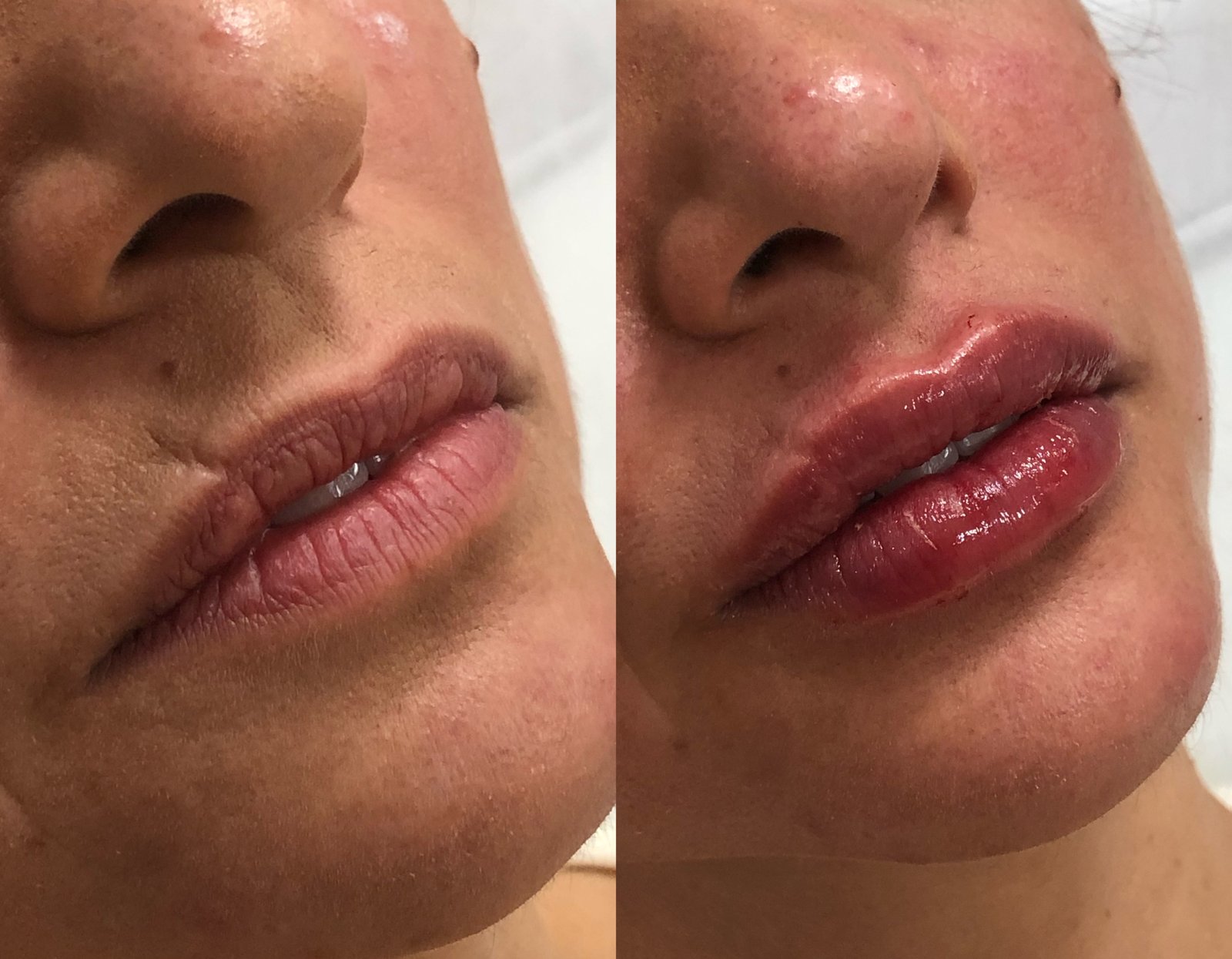 Preenchimento Labial - antes e depois - Cesof
