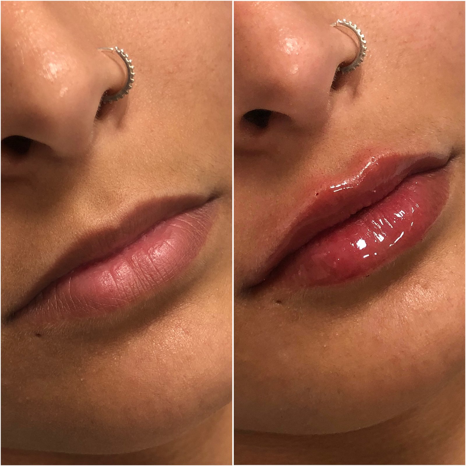 Preenchimento Labial - antes e depois - Cesof