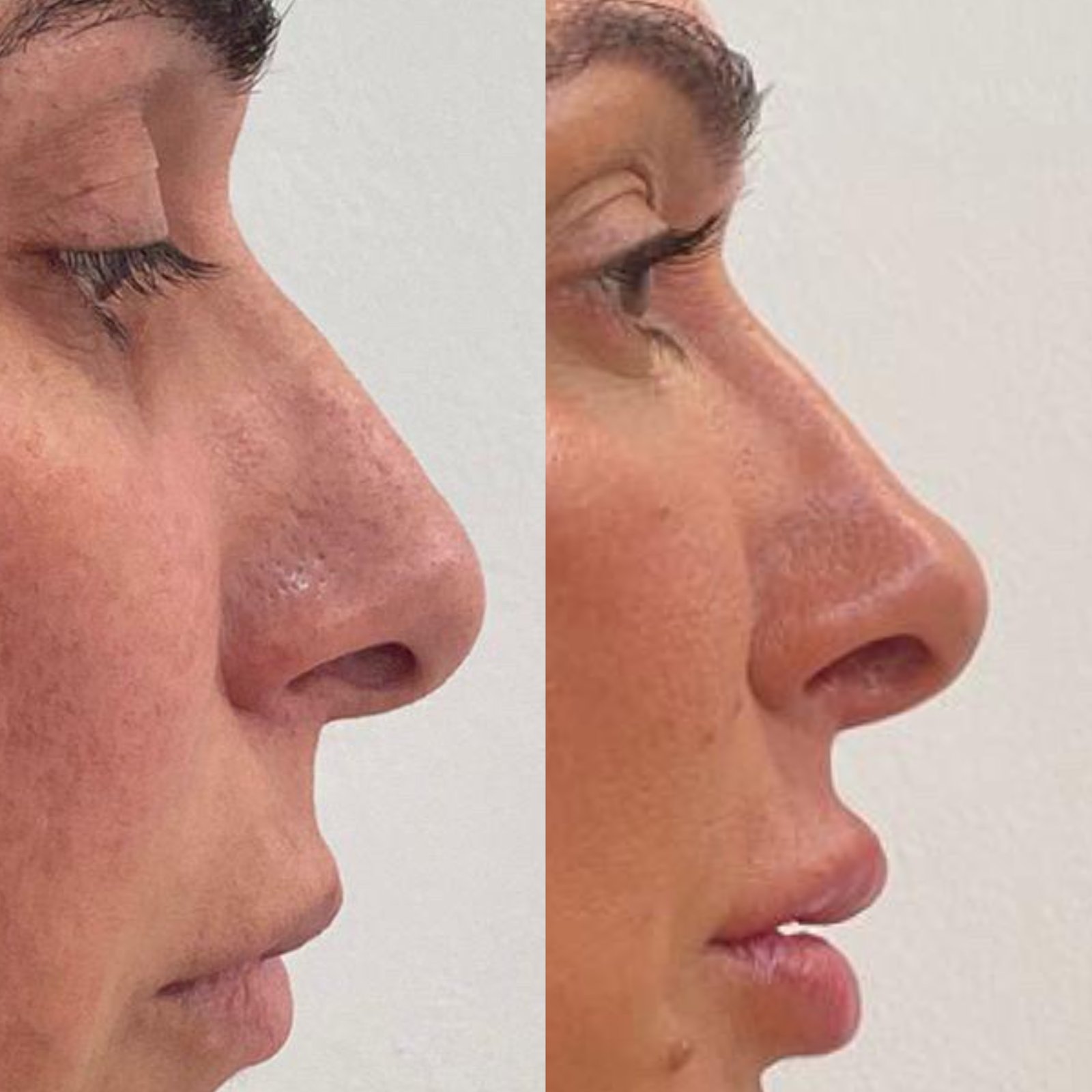 Preenchimento Labial - antes e depois - Cesof
