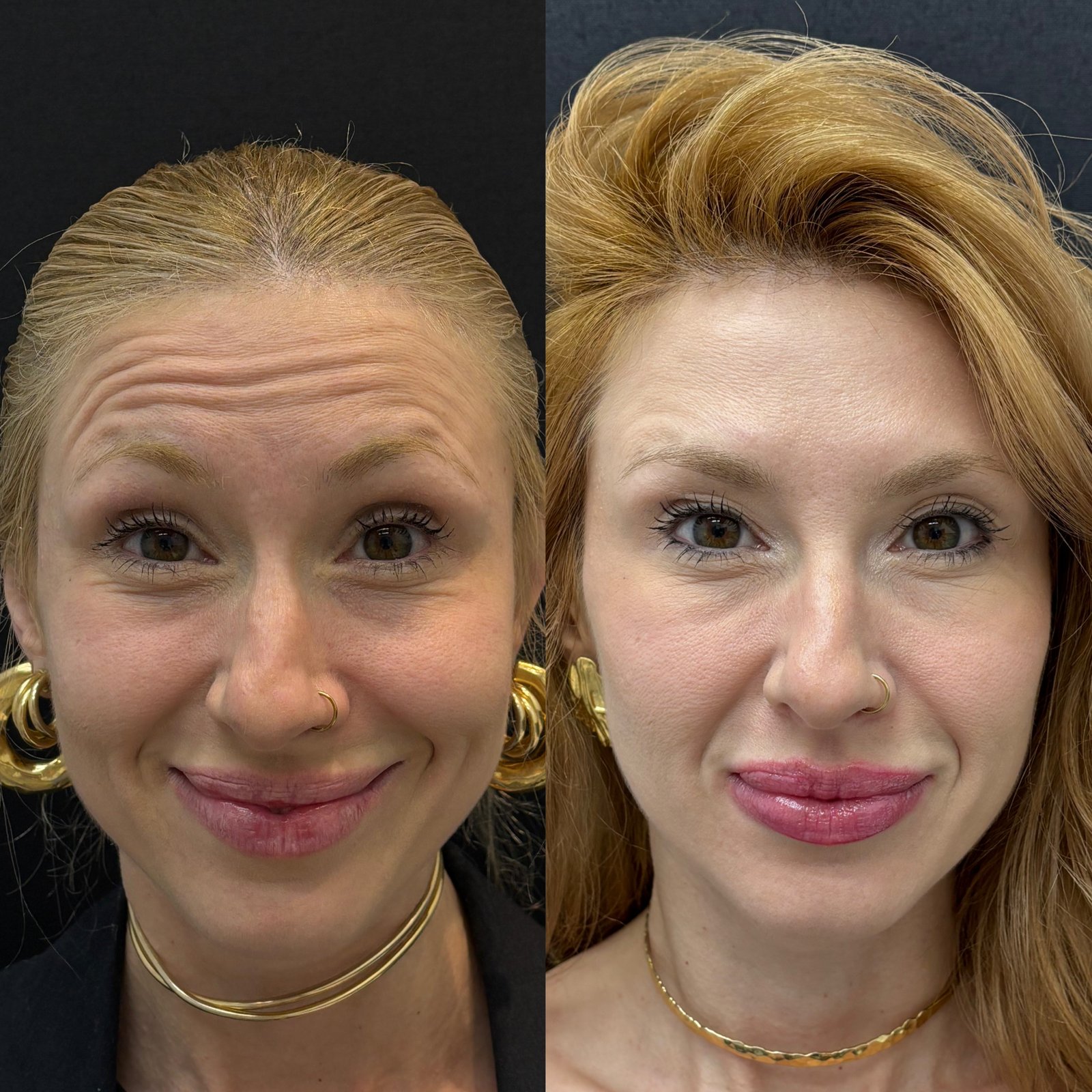 Toxina Botulínica - resultado antes e depois - Cesof