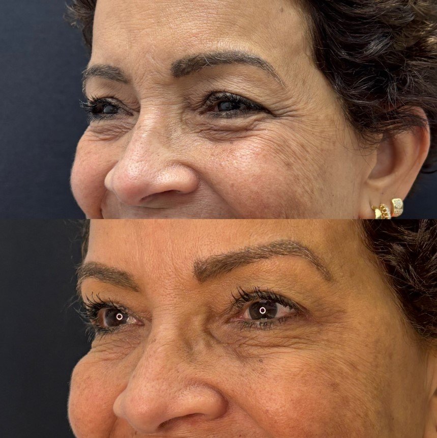 Toxina Botulínica - linhas de expressão antes e depois - Cesof