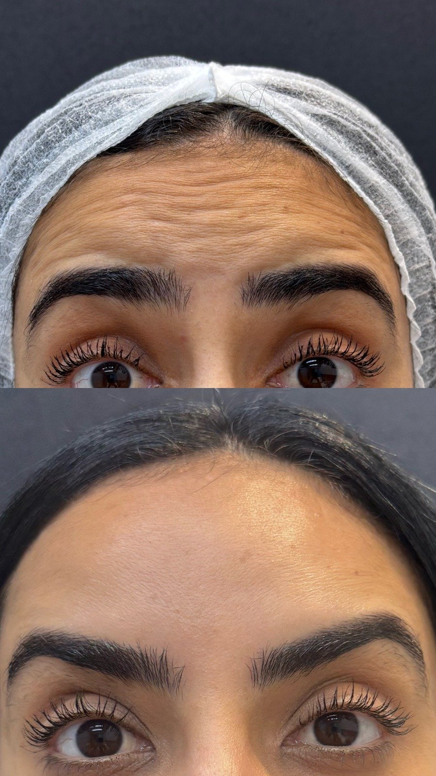 Toxina Botulínica - testa antes e depois - Cesof