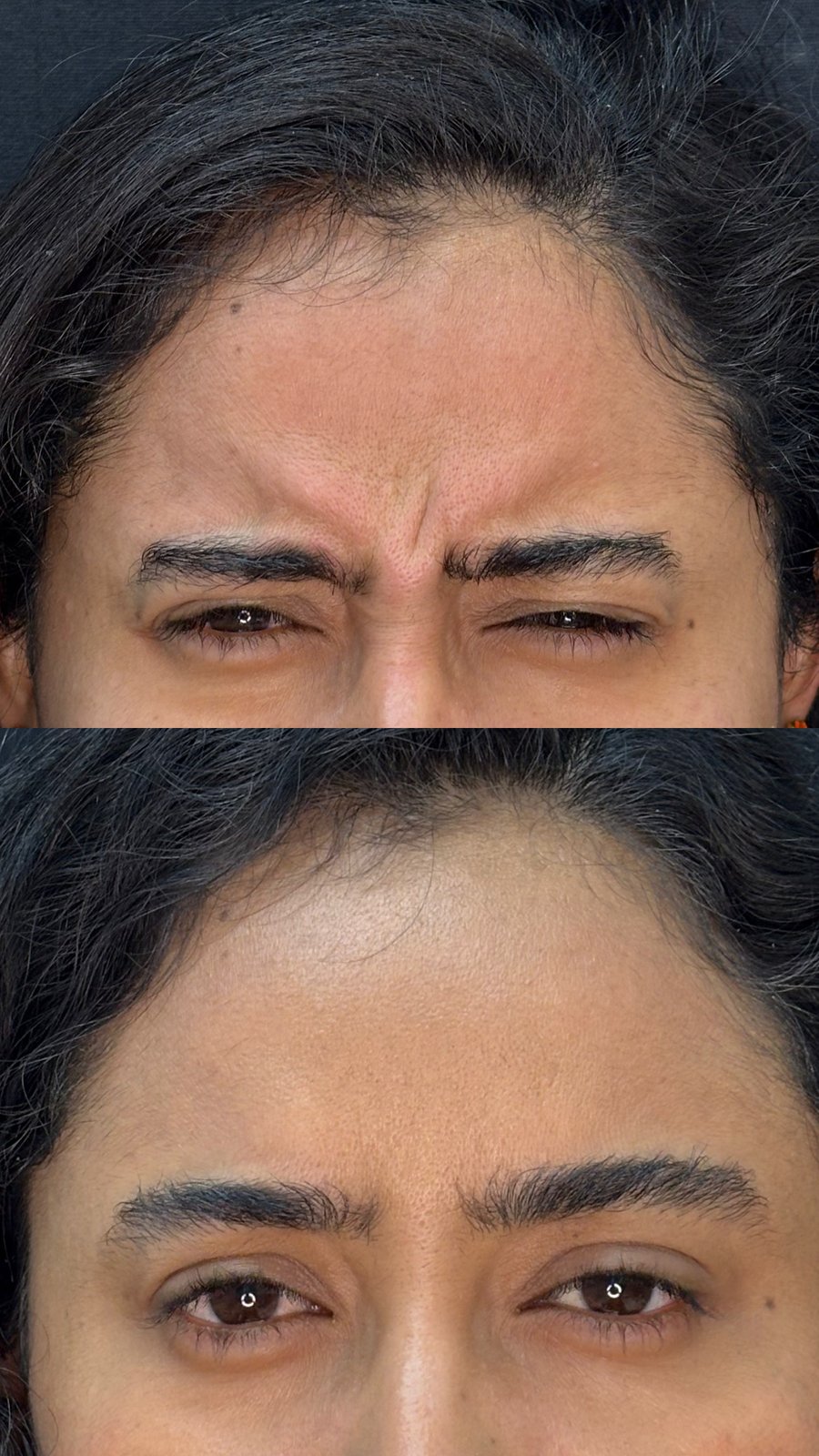 Toxina Botulínica - pés de galinha antes e depois - Cesof