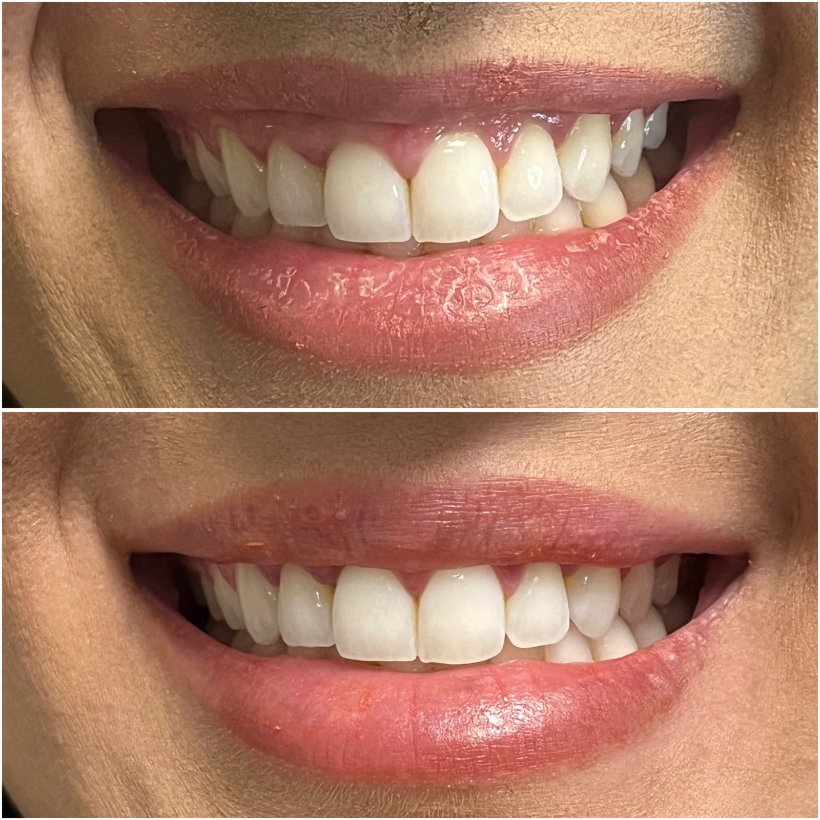 Toxina Botulínica - testa antes e depois - Cesof