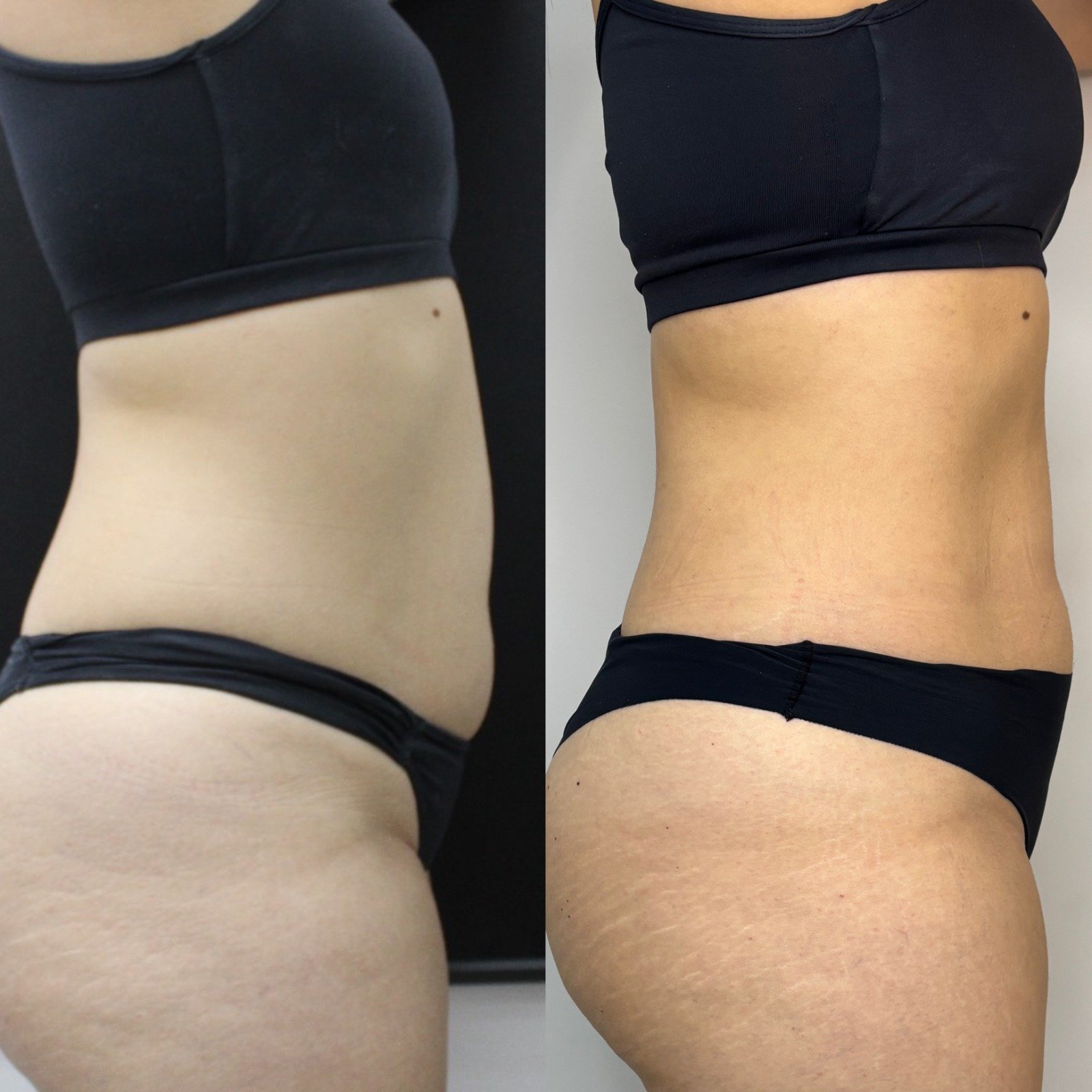 Ultrassom Macrofocado - antes e depois corpo - Cesof