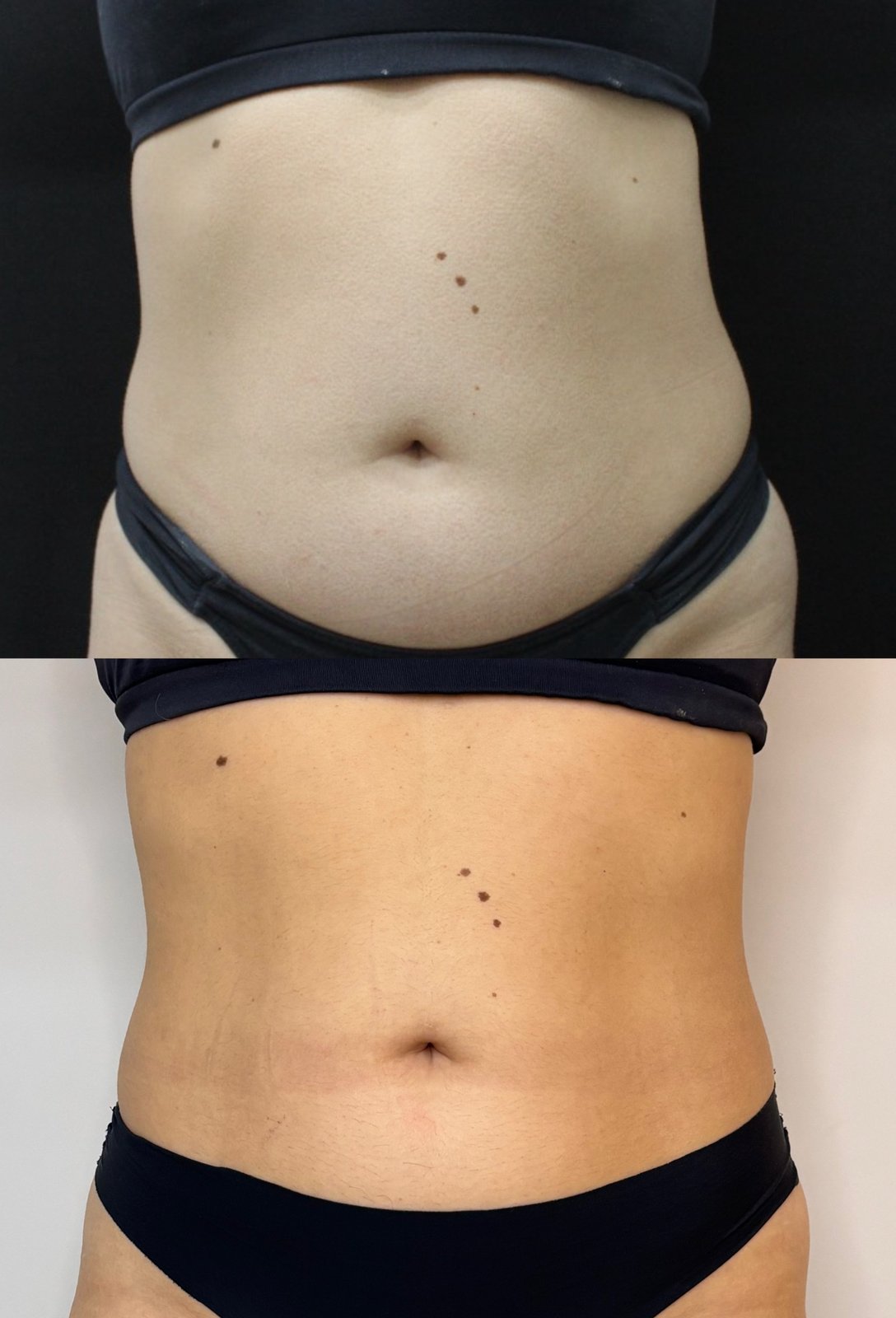 Ultrassom Macrofocado - antes e depois corpo - Cesof