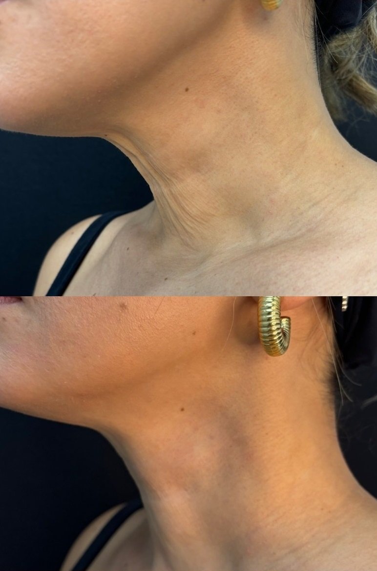 Ultrassom Microfocado - antes e depois - Cesof