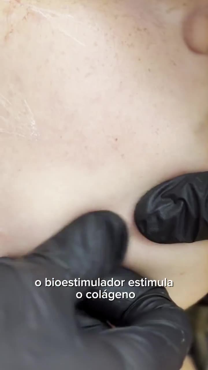 Bioestimulador de Colágeno - vídeo - Cesof