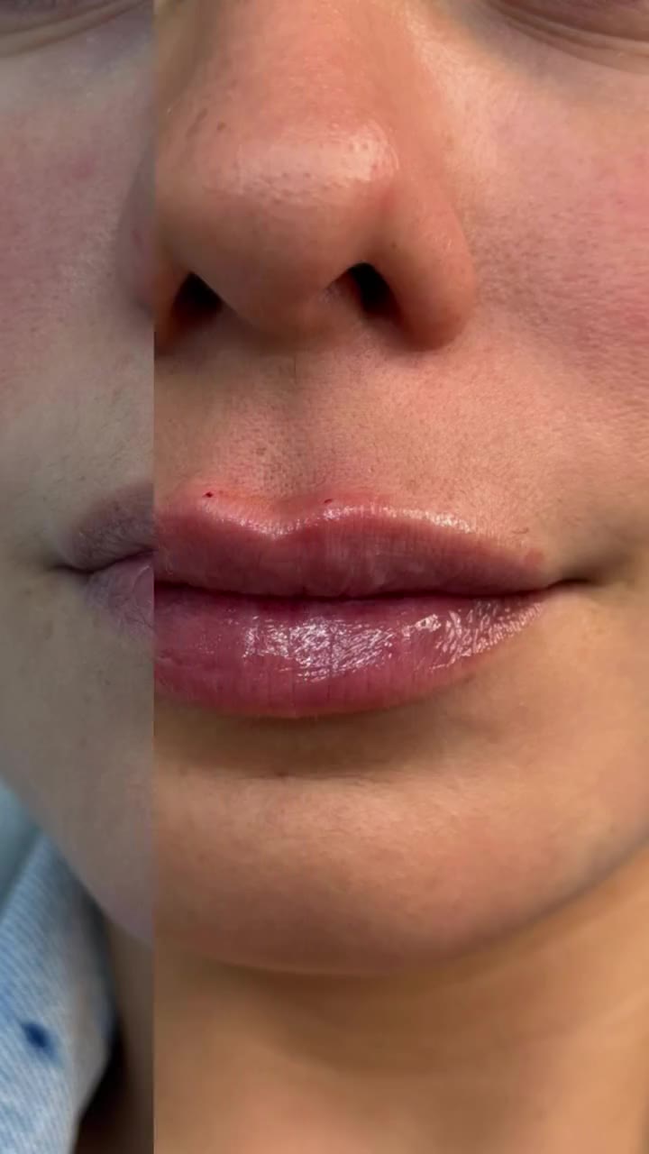 Preenchimento Labial - vídeo 2 - Cesof