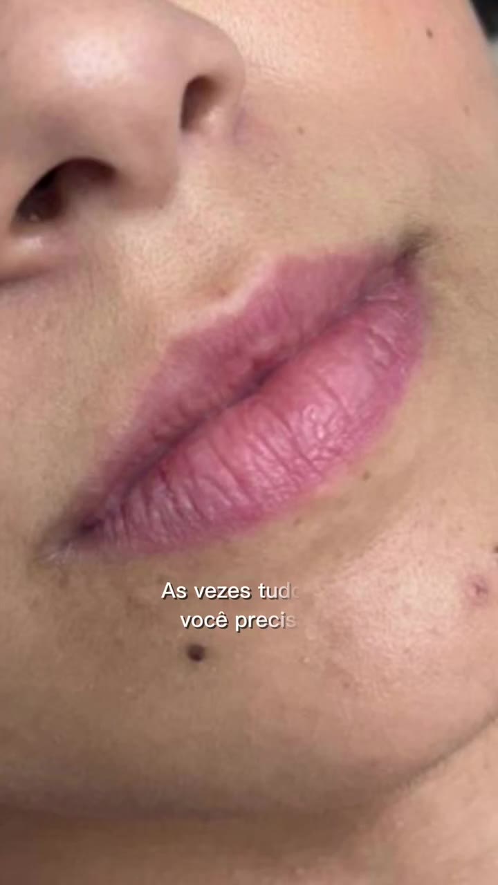 Preenchimento Labial - vídeo 3 - Cesof