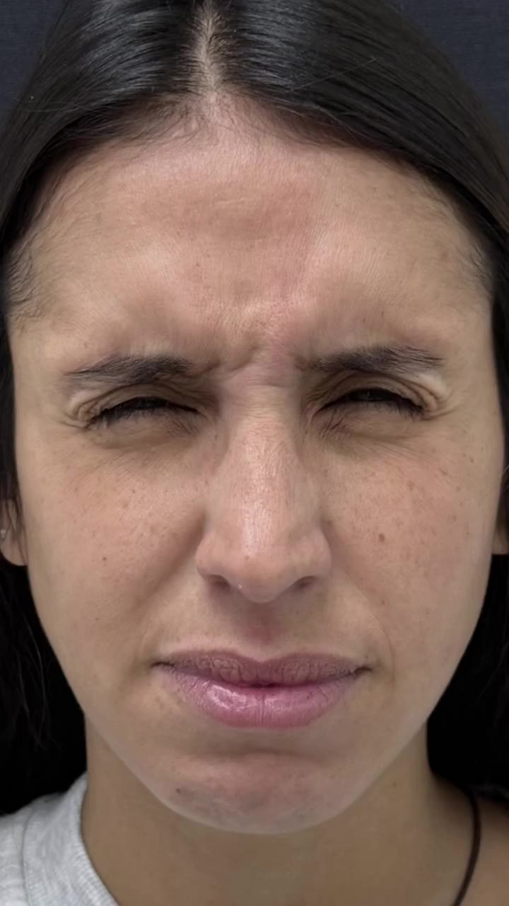Toxina Botulínica - vídeo 2 - Cesof